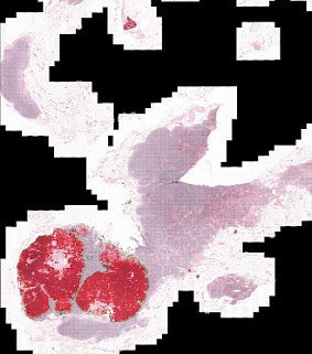 machine image of tumors in a body